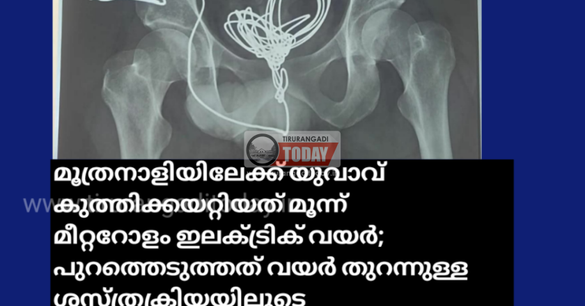 മൂത്രനാളിയിലേക്ക് യുവാവ് കുത്തിക്കയറ്റിയത് മൂന്ന് മീറ്ററോളം ഇലക്ട്രിക് വയർ; പുറത്തെടുത്തത് വയർ തുറന്നുള്ള ശസ്ത്രക്രിയയിലൂടെ